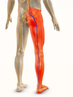 An anatomical illustration of a human body from the back, highlighting the sciatic nerve. The left side shows the skeletal structure and yellow nerve pathways, while the right side is colored in red to emphasize the muscles, with a prominent blue line tracing the sciatic nerve from the lower spine, through the buttocks, and down the leg to the foot